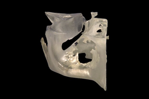 Stratasys Patient specific 3D printed surgical guide