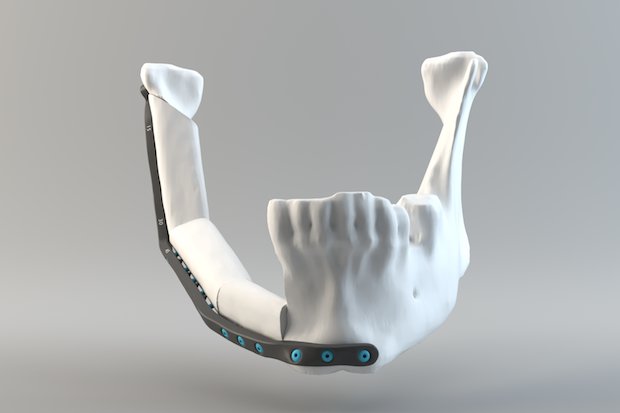 Render of a lower jaw implant.