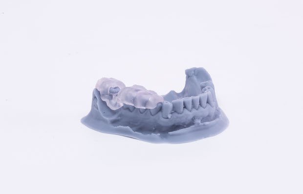 3D Printed Surgical Guide on a Dental Impression