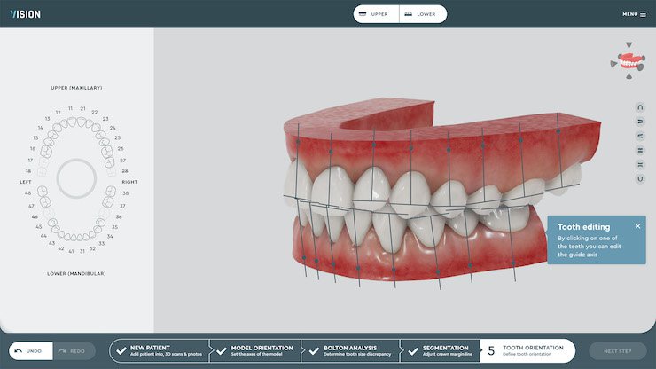 Tooth orientation on the SoftSmile software platform.