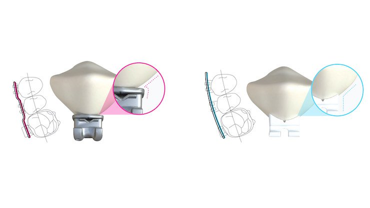 LightForce Orthodontics to further develop 3D printed teeth brackets product range after $14m investment