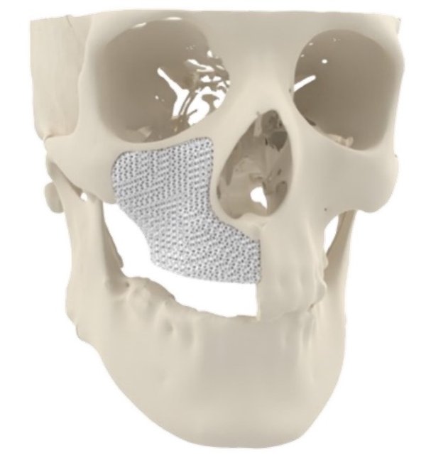 Example of MyBone 3D printed implant
