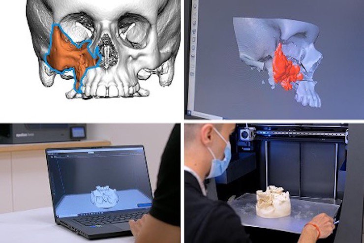 BCN3D technology being used to plan surgery