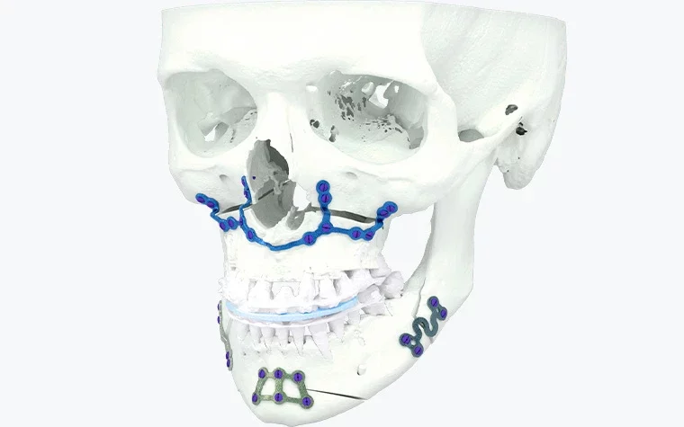 cimq-cranio-maxillofacial-orhtognathic-surgery-3d-printed-surgical-guides-skull-render.jpg.webp