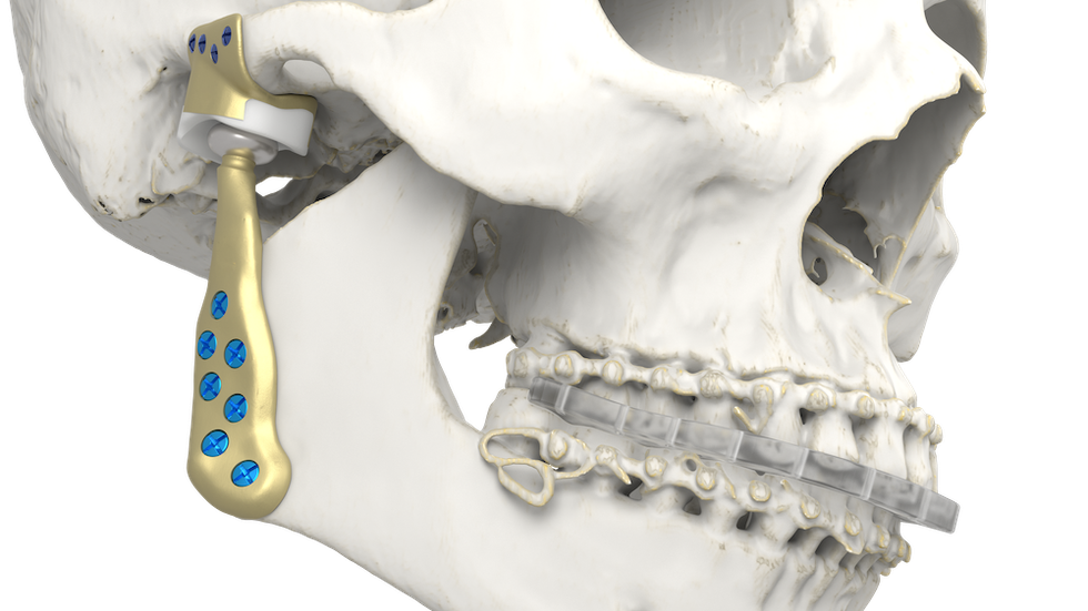Personalized TMJ implant rendering