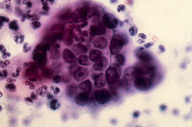 Cervical cancer cells