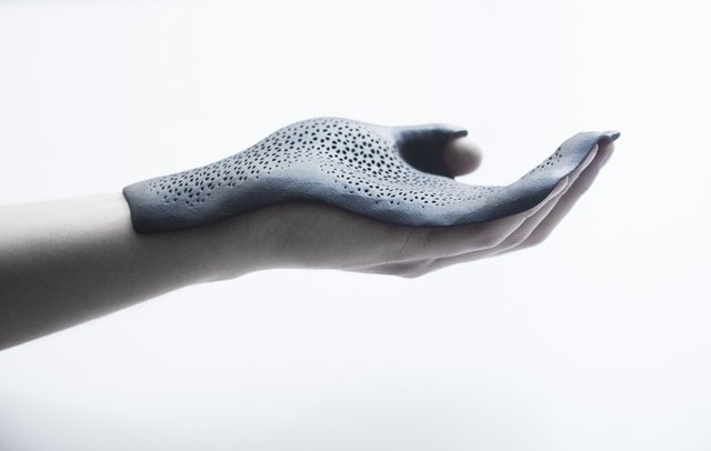 Windform 3DPrinted Bespoke Orthosis Hand