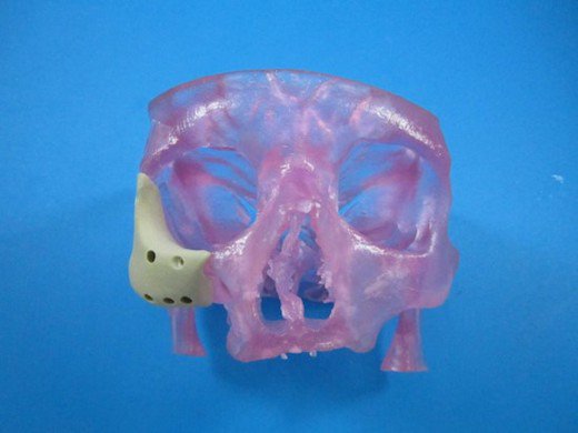 Facial Implant_Pink Plastic Face.jpg