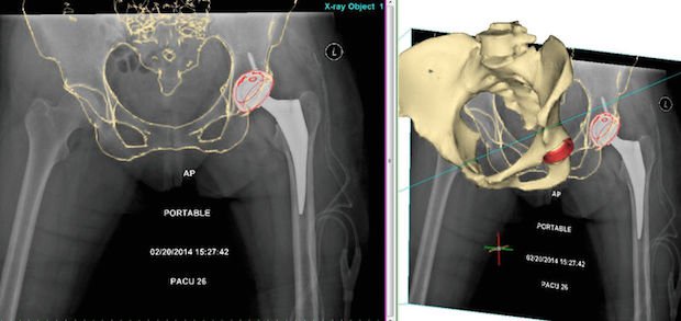 X-ray-and-pre-op-CT-1.jpg