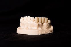 Microlay DentalFab temp crown
