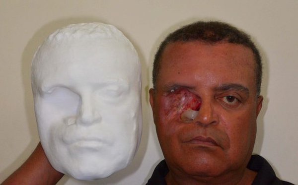 Plus ID Brazil 3D printed face prosthesis
