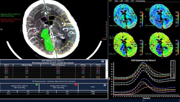 Phillips IntelliSpace Portal 9.0 brain imaging