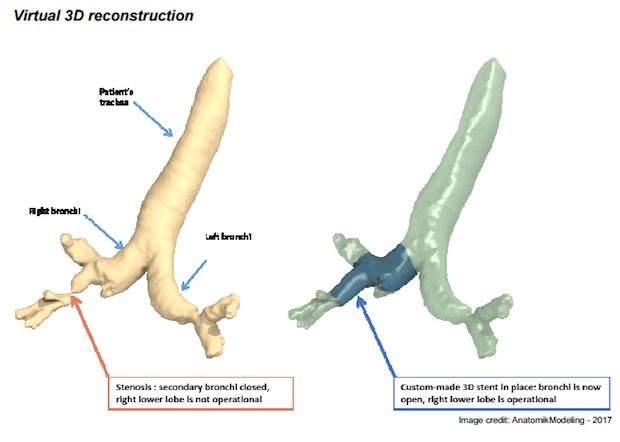 Toulouse doctors airway stents 3D reconstruction